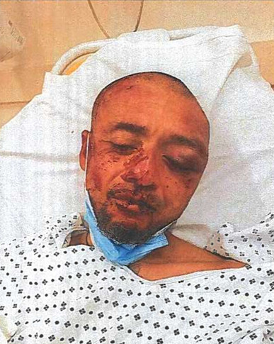 Charges Dismissed Against Man Whose Face was Fractured by SFPD During an Illegal Detention